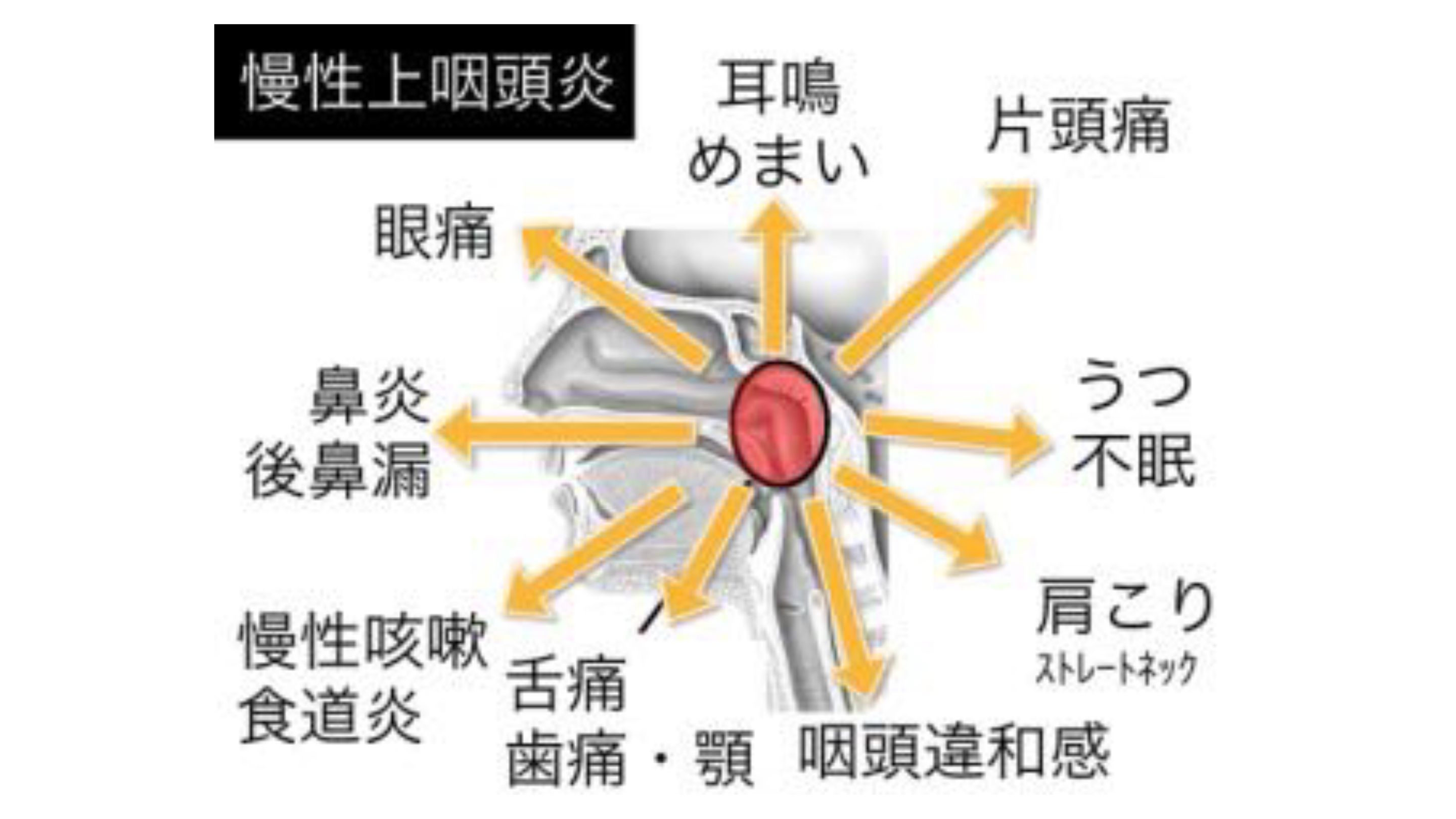 つらい不調が続いたら、慢性上咽頭炎を治しましょう