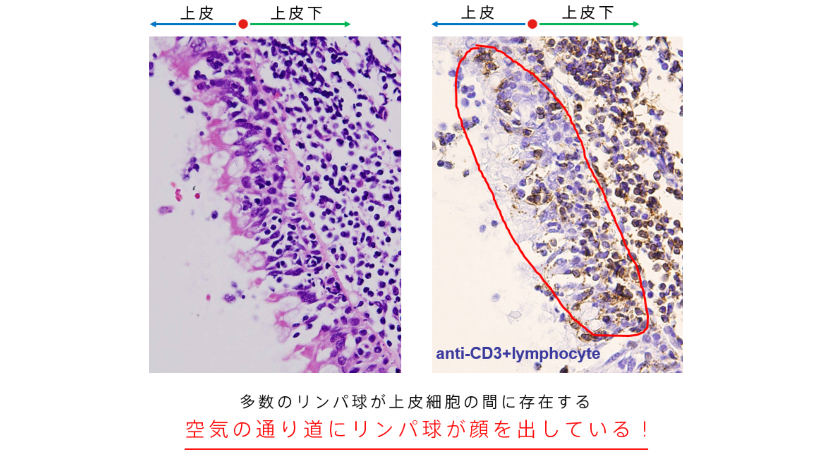 つらい不調が続いたら、慢性上咽頭炎を治しましょう