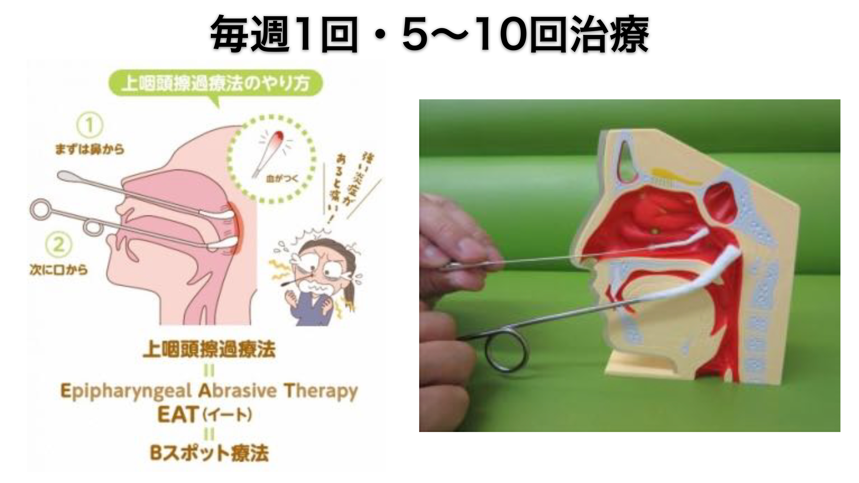 つらい不調が続いたら、慢性上咽頭炎を治しましょう
