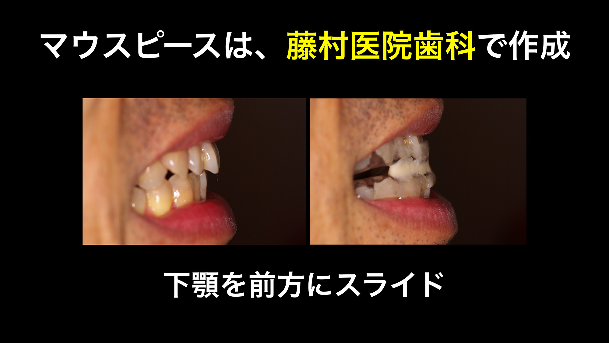 いびき